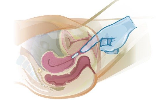 Vaginal Insertion