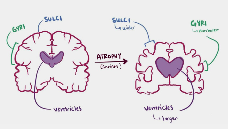 Growth of Neurotherapeutic Market-1