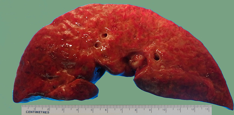 Kidney Stone And Liver Problem-1