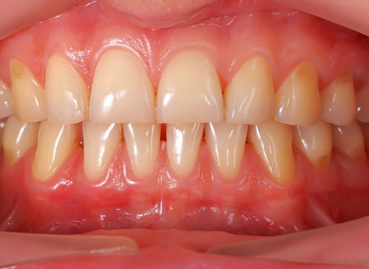 Gingival Oral Film