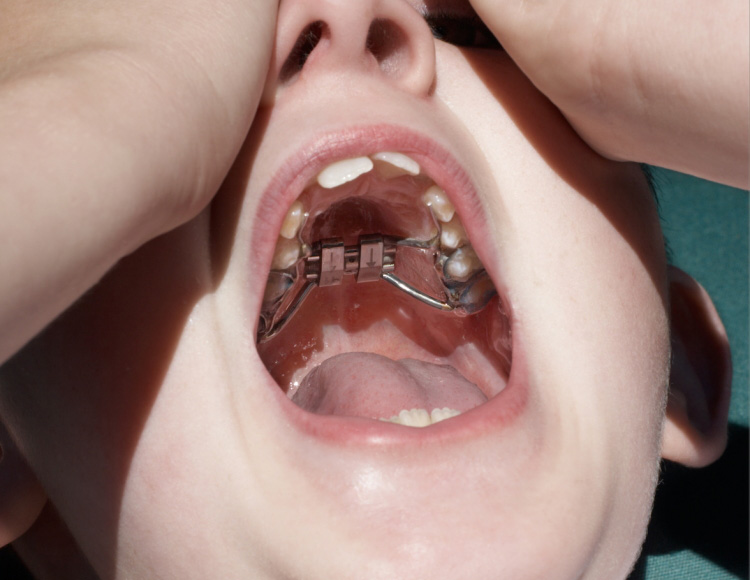 Palatal Oral Film