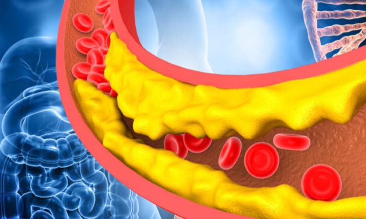 Hyperlipidemia