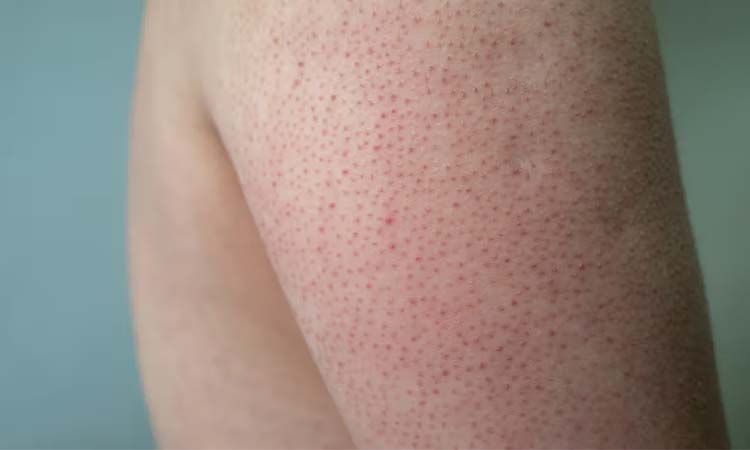 Keratin and skin problem