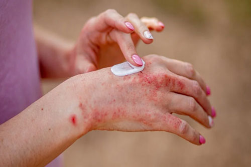 Skin condition