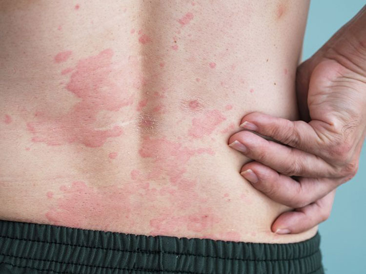 Allergic reaction