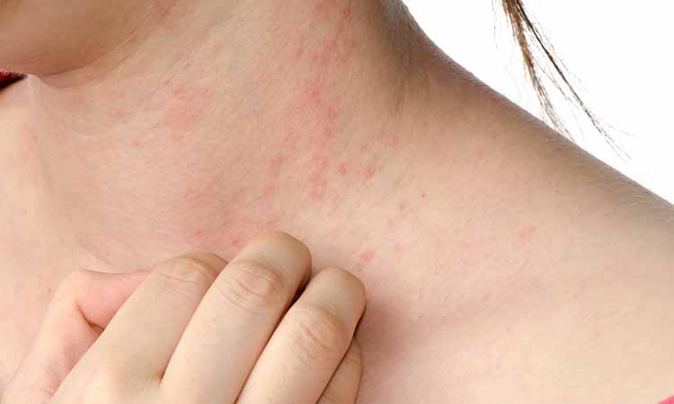 Allergy