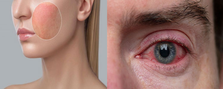 Skin and eye irritation