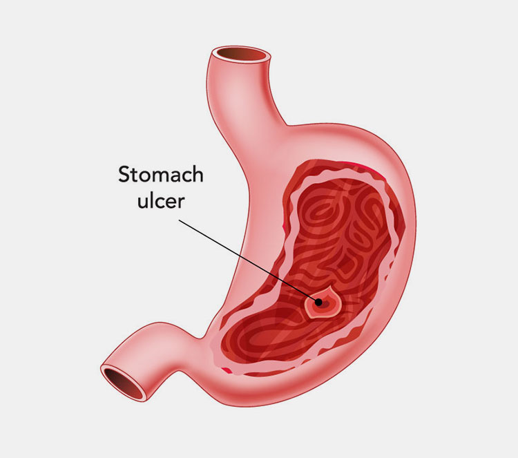 Stomach ulcer