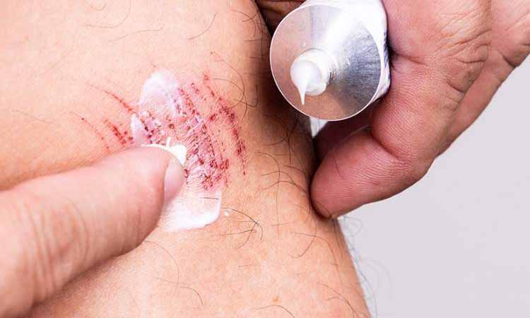 Wound healing