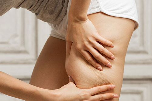 Excessive water retention