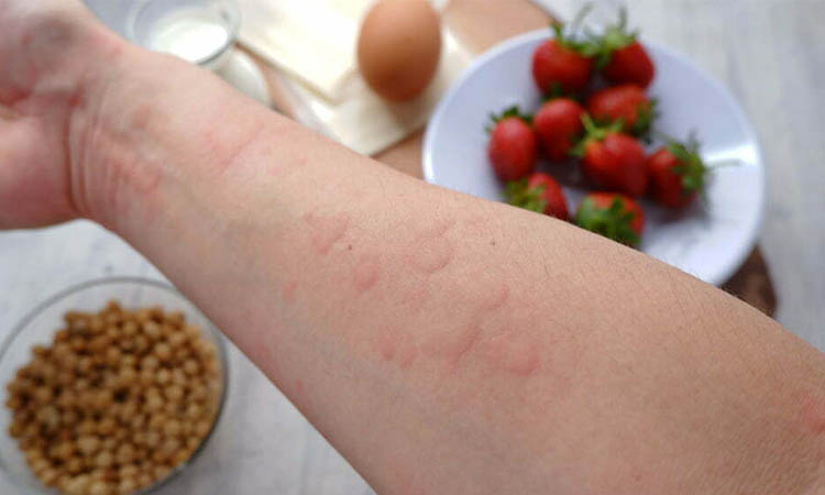 Food allergic