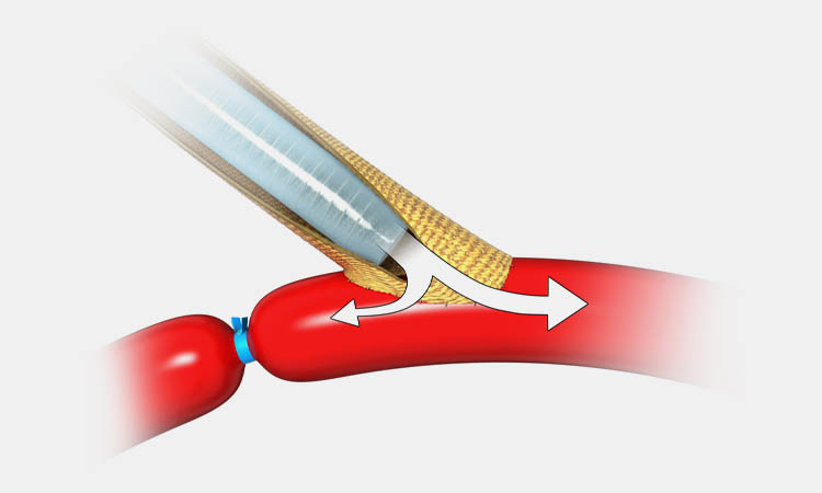 Vascular prosthetics